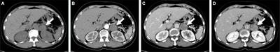 Case Report: Adrenal glands degenerated schwannoma: Report of three cases and literature review